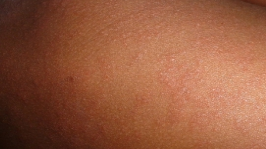 Measles Transmission in New South Wales